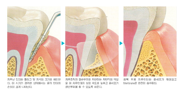 골조직과 치주조직 재생 위한 완벽한 만남