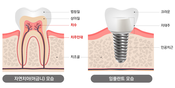 임플란트에는 자연치아에 있는 치수나 치주인대가 없다 