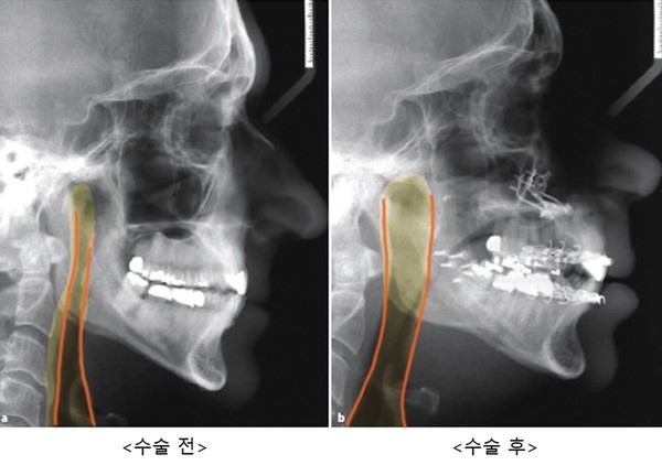 양악 전진술을 통해 넓어진 상기도(주황색)