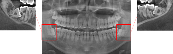 사랑니로 인해 인접치가 손상된 모습